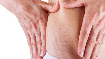 New mom says stretch marks are 'nothing to be ashamed of'