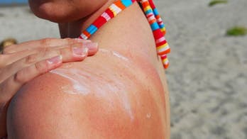 Severe sunburns early in life linked to higher melanoma risk