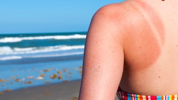 Here's how damaging a bad sunburn can be