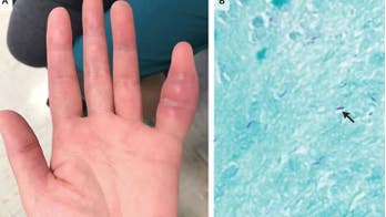 Woman's swollen pinkie was rare sign of tuberculosis
