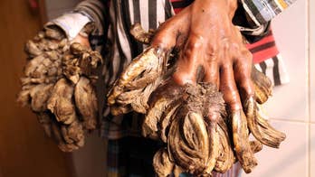 'Tree Man' has surgery: What causes this rare condition?