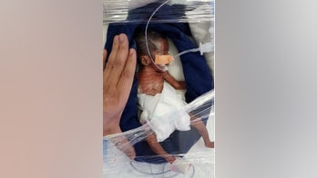 'Micro-preemie' twin babies born at 24 weeks weighing 1.3 pounds