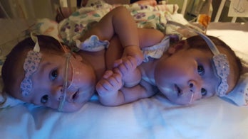 In rare surgery, docs use 3-D printing to separate twins conjoined at heart