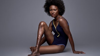A woman mocked for her ugly leg takes revenge and becomes a model