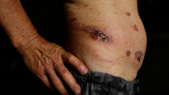 Flesh-eating ulcer 'epidemic' in Australia stumps doctors