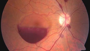 Handstand pushups cause man to lose vision temporarily