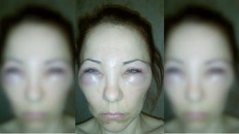 Woman gets snake venom injection instead of Botox