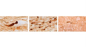 Explosive blasts leave distinct injuries in veterans’ brains, study finds