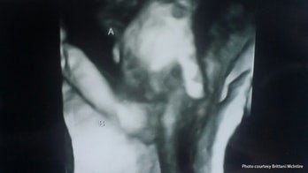 Heartbreaking sonogram image depicts dying twin holding sister's hand