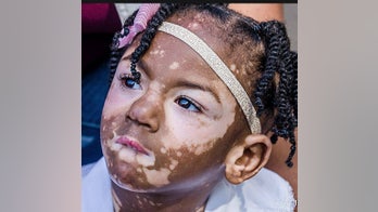 5-year-old girl develops blotchy skin disease all over her body triggered by meningitis