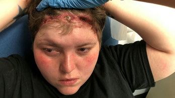 Woman left with 6-inch scalp gash from too-tight weave
