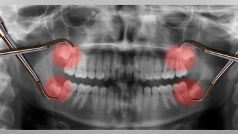 Still little evidence for removal of symptom-free wisdom teeth