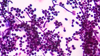 History of yeast infection may increase risk of psychiatric disorders