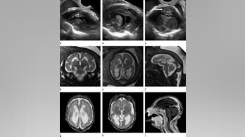 New images detail how Zika attacks developing brains