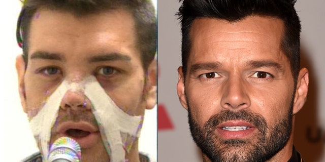 Fran Mariano after his surgery to look like Ricky Martin.