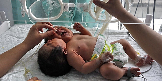 May 9: Medical workers attend to conjoined twin babies with a single body and two heads born on May 5 in a hospital in Suining city in southwestern China's Sichuan province.