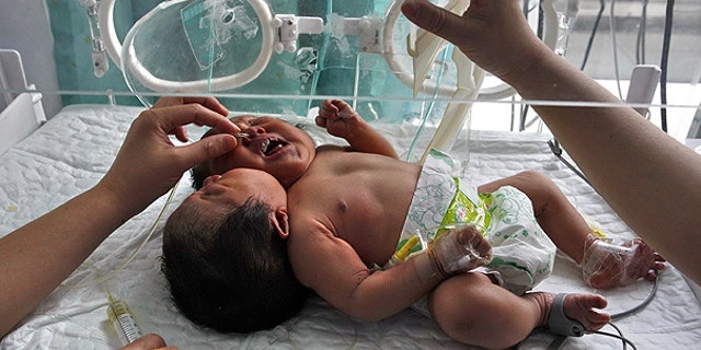 May 9: Medical workers attend to conjoined twin babies with a single body and two heads born on May 5 in a hospital in Suining city in southwestern China's Sichuan province.