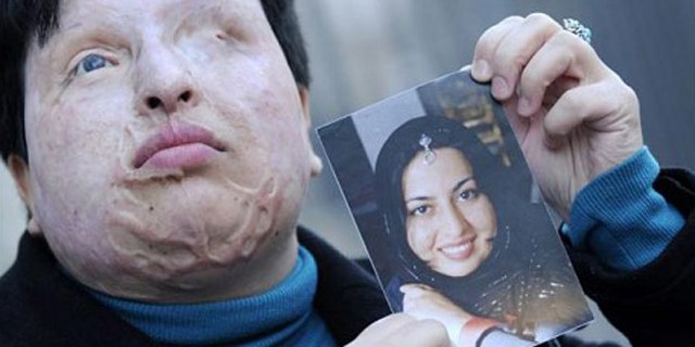 Photo of Ameneh Bahrami after the attack.