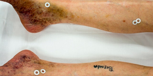 Injuries to Doyle Lee Hamm after his "botched" execution last month.