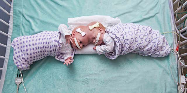 This September 2016 photo provided by the Children's Hospital of Philadelphia shows conjoined twin girls Abby Delaney, right, and Erin at the Children's Hospital of Philadelphia in Philadelphia.