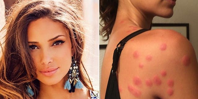Sabrina Jales St. Pierre bug bites