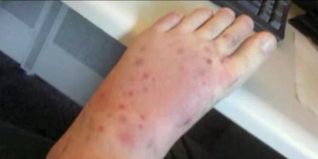 Jeff Seale suffered 19 black widow spider bites on his left foot; his sister is convinced that the man ultimately died from the poisonous bites.