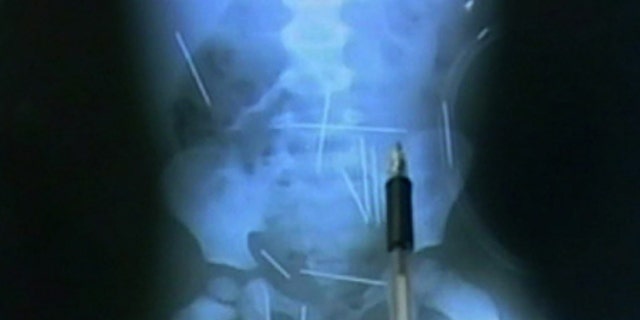 In this frame taken from a TV Globo video, a person points at a X-ray of a 2-year-old boy showing needles inside his body in a hospital in Ibotirama.