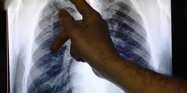 Clinical lead Doctor Al Story points to an x-ray showing a pair of lungs infected with TB (tuberculosis) during an interview with Reuters on board the mobile X-ray unit screening for TB in Ladbroke Grove in London January 27, 2014. REUTERS/Luke MacGregor