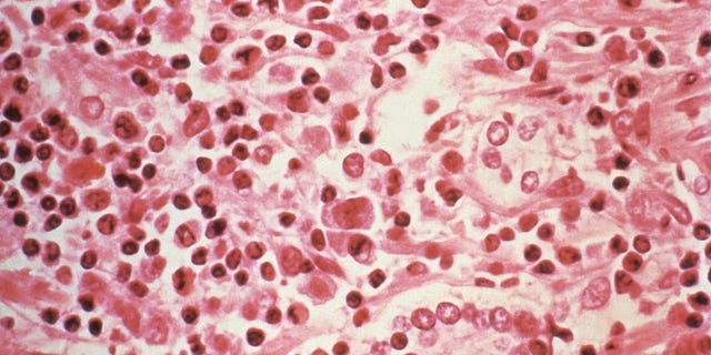 A micrographic study of liver tissue seen from a Hantavirus pulmonary syndrome (HPS) patient

