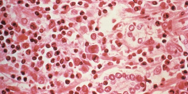 A micrographic study of liver tissue seen from a Hantavirus pulmonary syndrome (HPS) patient