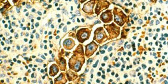 This image shows metastasized human breast cancer cells (magnified 400 times, stained brown) in lymph nodes.