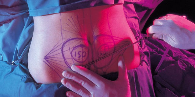 Liposuction Detail of the drawn stomach of an awake woman in the liposuction operation (Photo by Luis Davilla/Cover/Getty Images)