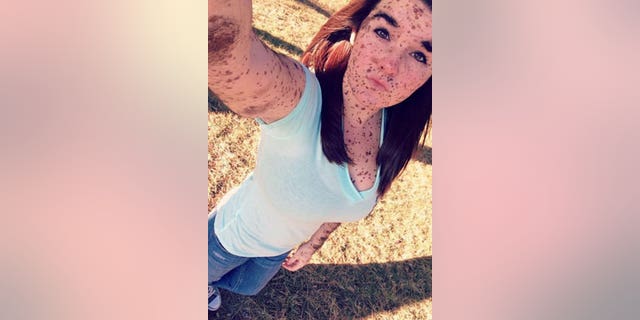 19 Year Old Born With Body Covered In Birthmarks Is ‘proud To Be