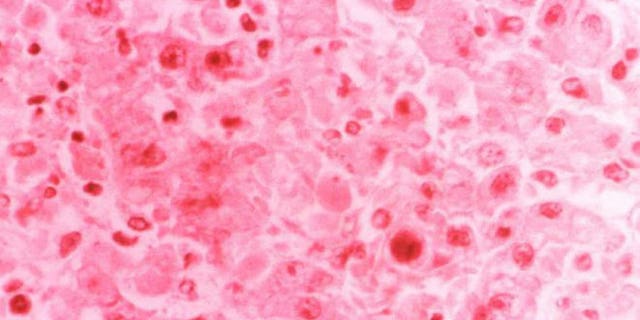 This hematoxylin-eosin-stained (H&E) photomicrograph depicts the cytoarchitectural changes found in a liver tissue specimen extracted from a Lassa fever patient.