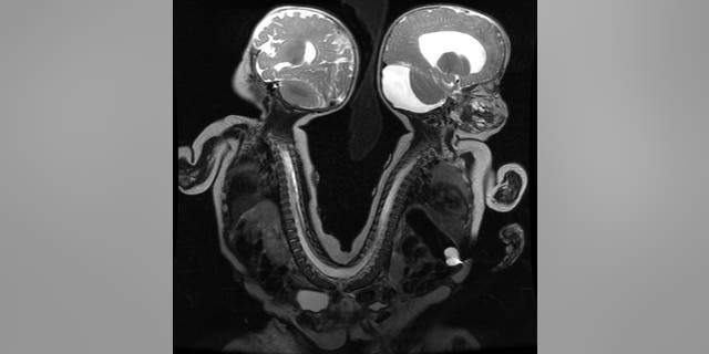 The conjoined twins in a MRI image before they were separated.
