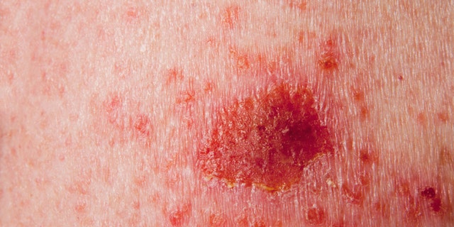 Close up of a basal cell carcinoma skin cancer.