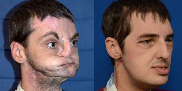 Richard Norris after a gun accident and seven months after receiving a full face transplant.