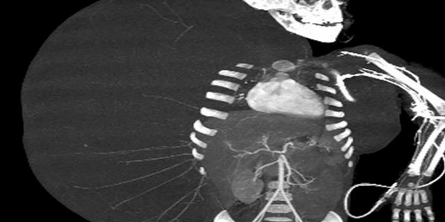 In this still image taken from an undated video released by the Mexican Social Security Institute (IMSS) on Tuesday, June 26, 2012, an image created through medical imaging technology shows an X-ray-like image of 2-year-old Jesus Rodriguez, prior to having a benign tumor removed from his body.