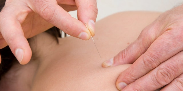 acupuncture