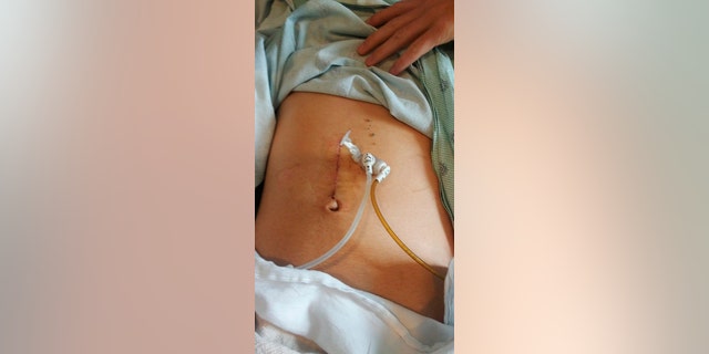 Alex still goes to the hospital every few weeks to get a balloon inserted into his esophagus to stretch it, so he doesn't choke.
