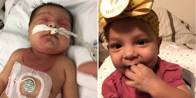 Annaleise was born with red bumps on her body that were eventually diagnosed as leukemia. The nearly 9-month-old is now considered cancer-free.