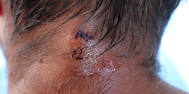 April 22, 2013 - French fisherman Yoann Galeran displays a cut to his neck while on board the FV Ruby in Gove Harbour, near Nhulunbuy, Australia.