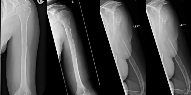 Bone Gone