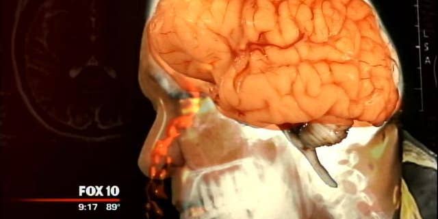 An image of Joe Nagy's brain, which was leaking fluid through his nose.