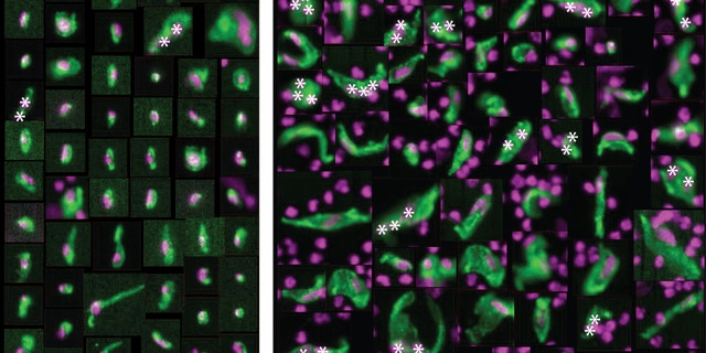 On the left are normal, healthy cells that line the coronary artery -- also known as circulating endothelial cells (CEC). On the right are CECs from heart attack patients which appear abnormally large, misshapen and with multiple nuclei.