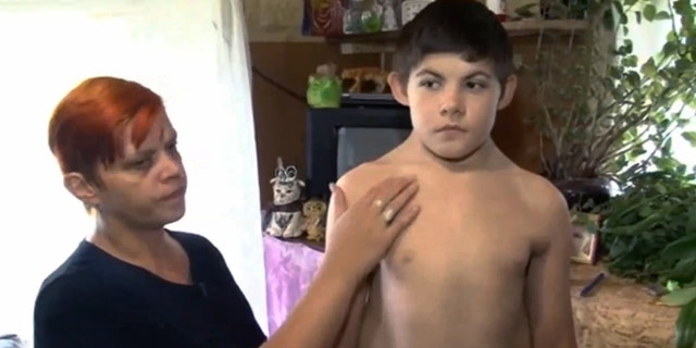 Valery Zhulanov, 13, is in agony because he is growing a second pair of ribs.