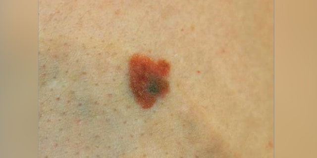 A photograph of the cancerous mole.