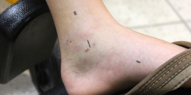 Visible side-by-side puncture marks.