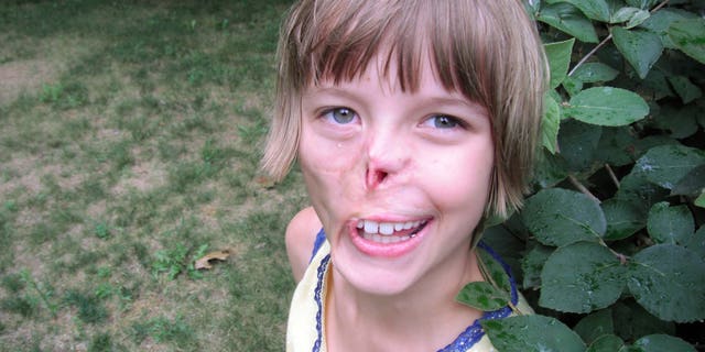 Charlotte Ponce's face was mauled by a pet raccoon in 2002 when she was 3 months old. (AP Photo/Ponce Family)