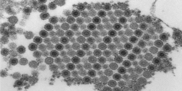 Numerous Chikungunya virus particles, which are composed of a central dense core that is surrounded by a viral envelope.